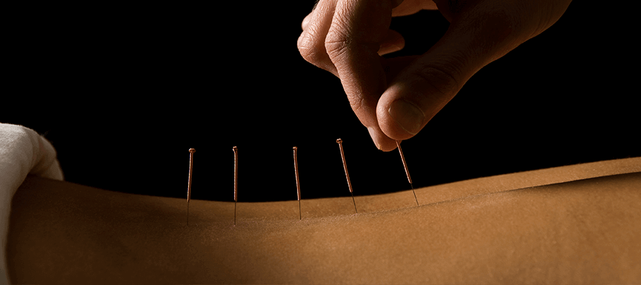 Acupuncture in Vero Beach, FL